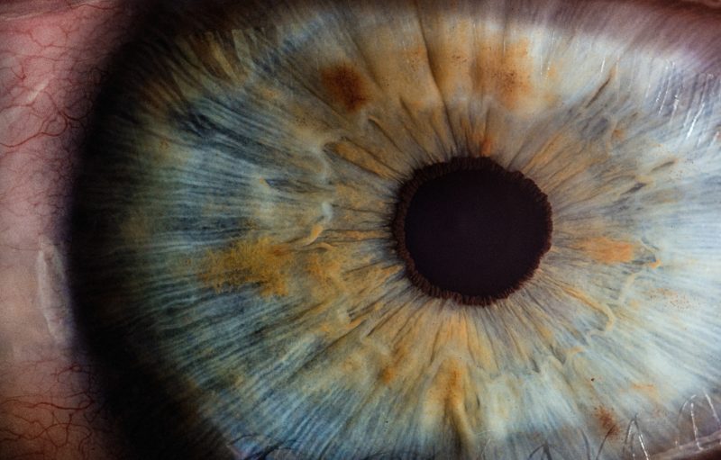 close up of eye conditions